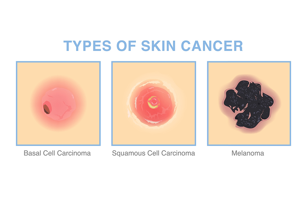 Illustration of various types of skin cancer Illustration for understanding different skin cancer lesions