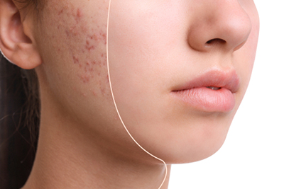 Acne-Treatment-in-Covington-LA